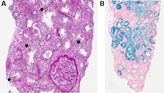 A: Periodic acid-Schiff染色 400倍、B: プルシアンブルー染色 200倍
